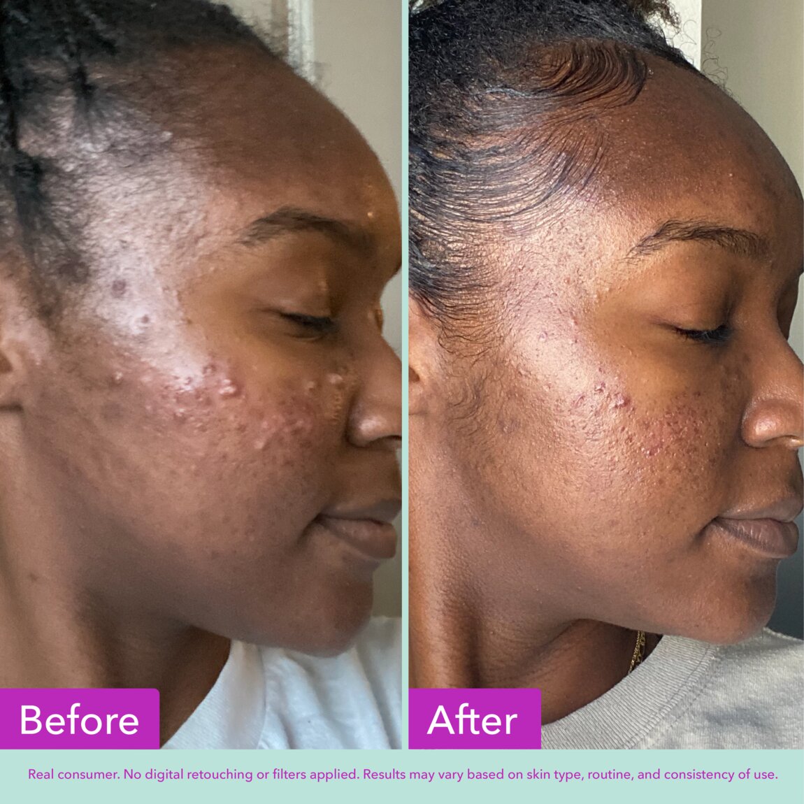 acne-foaming-cleanser-i0 zb_p.jpg