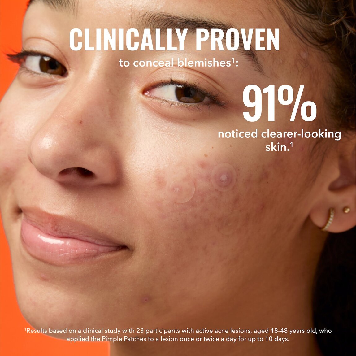 pimple-patches-l1 zb_p.jpg